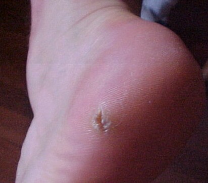 common wart images. images common wart on hand. common common wart on foot.