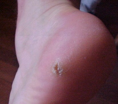 http://gbronline.com/rr22/Plantar-Foot-Wart.html
